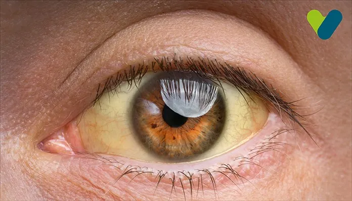 Jaundice Diet : Best Foods To Eat & Avoid In Jaundice