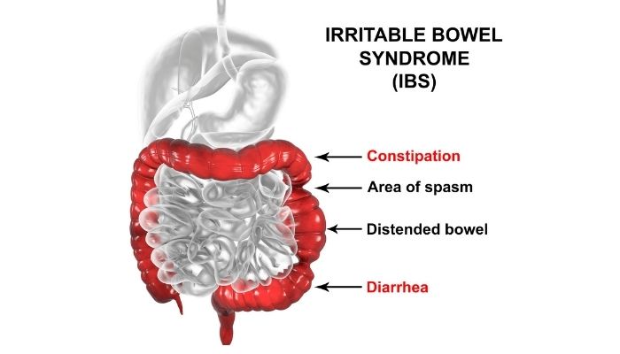 IBS