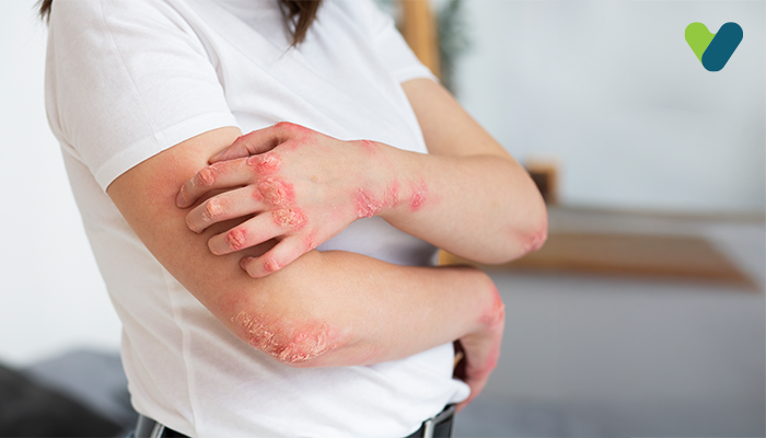 The Best Treatments For Tinea (Pityriasis )Versicolor And Red Patches