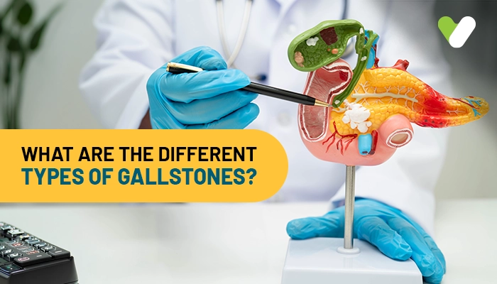 What are the different types of Gallstones? 