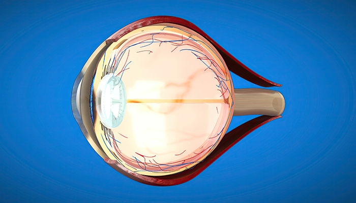 What is an Eye Cataract