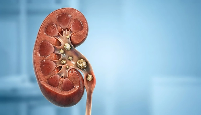 Cause of Kidney Stone in Women