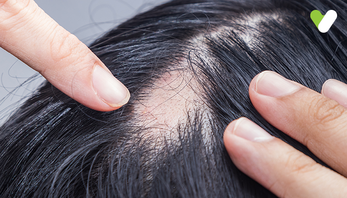 What Is Folliculitis Decalvans? Symptoms, Diet Tips, and Chronic Folliculitis Treatment