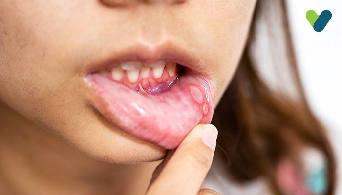 Get Rid Of Mouth Ulcer Through Home Remedies
