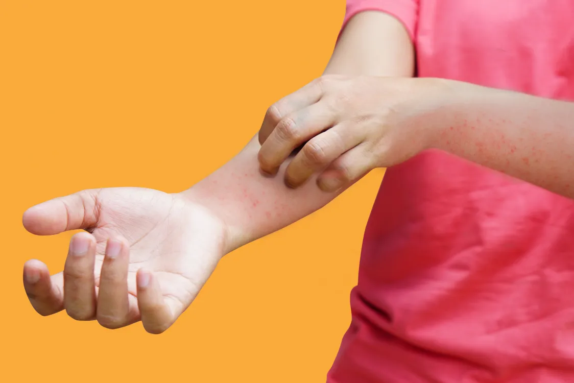 Hand-foot-mouth disease cases in kids ascending