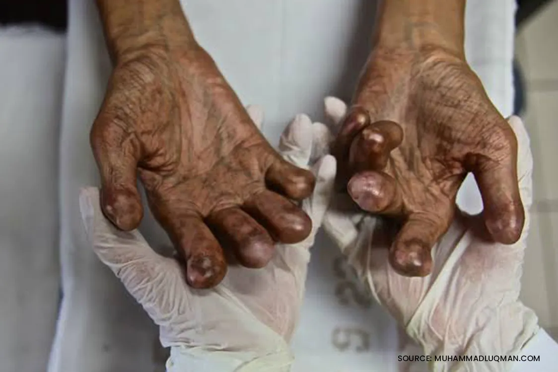 5% of the Leprosy cases in Maharashtra