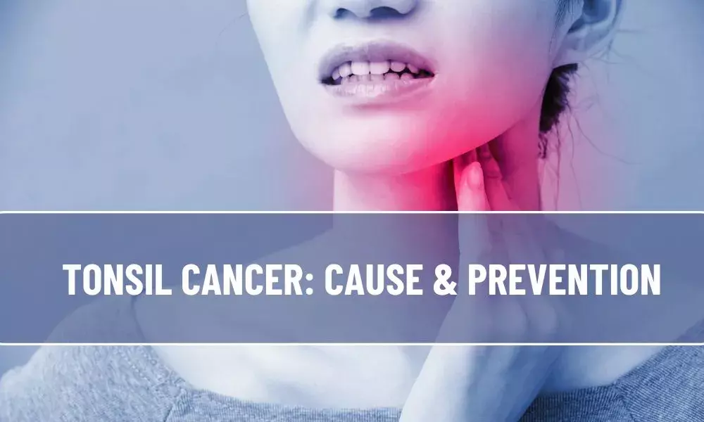 Tonsil cancer: Cause & Prevention
