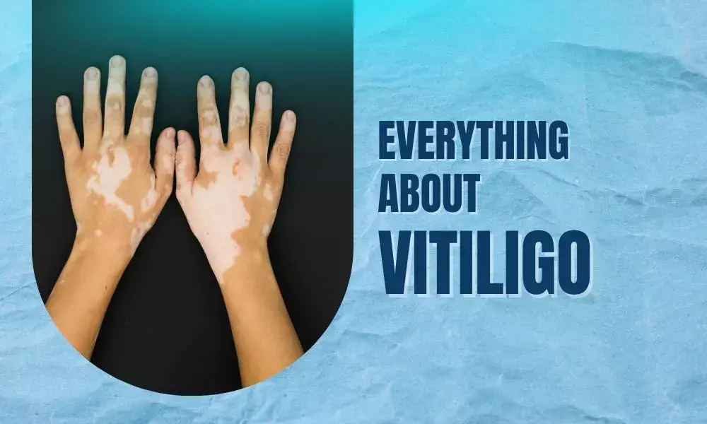 Everything about Vitiligo: You must know!