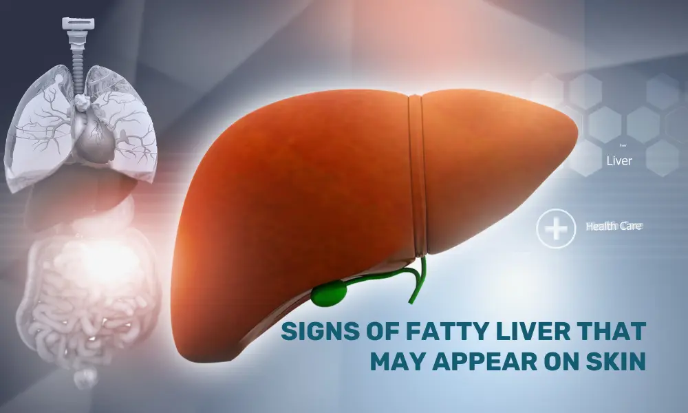 Signs Of Fatty Liver that may appear on skin