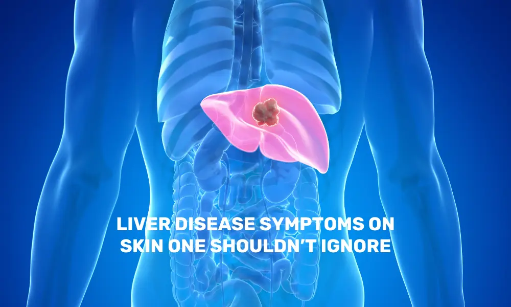 Signs of Liver Disease on Skin