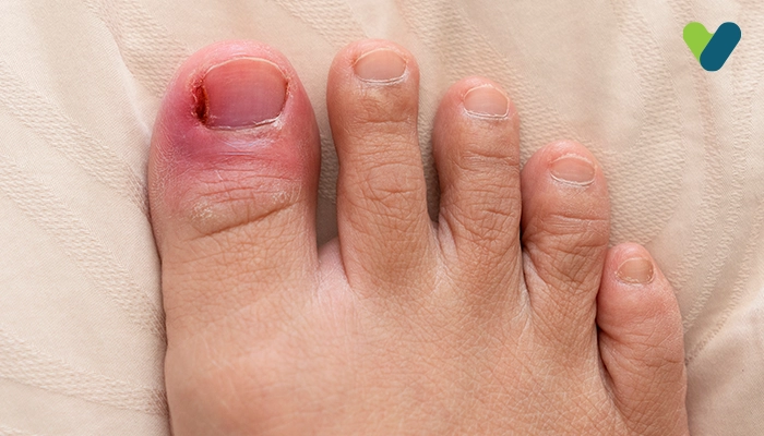 Ingrown Toe Nail – Is It Curable Or Not?