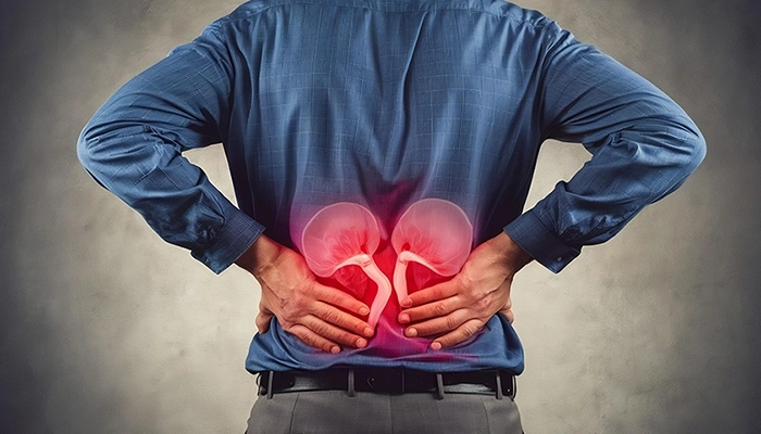 Kidney Stone Symptoms in Women