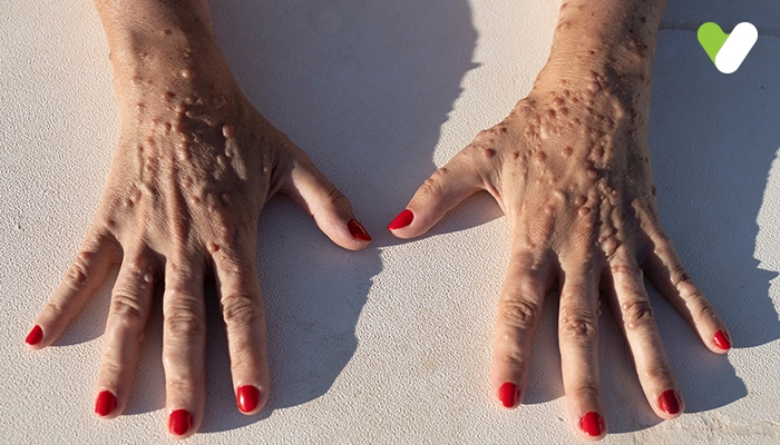 Understanding Neurofibroma: Treatment and Management for Patient