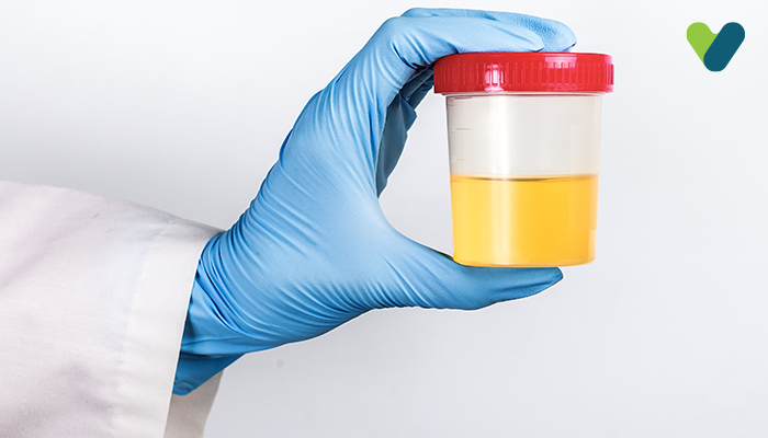 Urine Test (Microscopic & Routine Culture) – All About Urinalysis