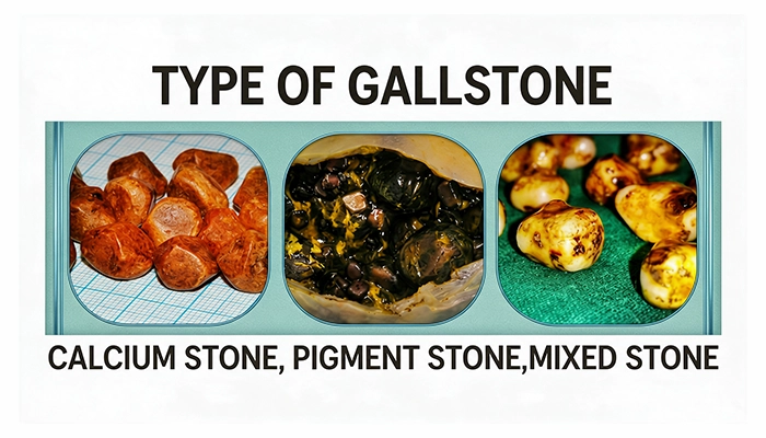 what are the 3 types of gallstones