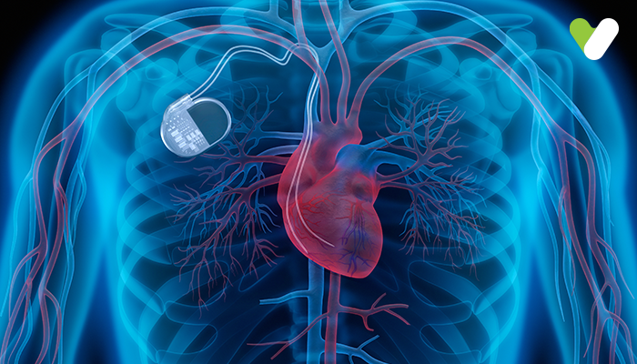 What is sick sinus syndrome?