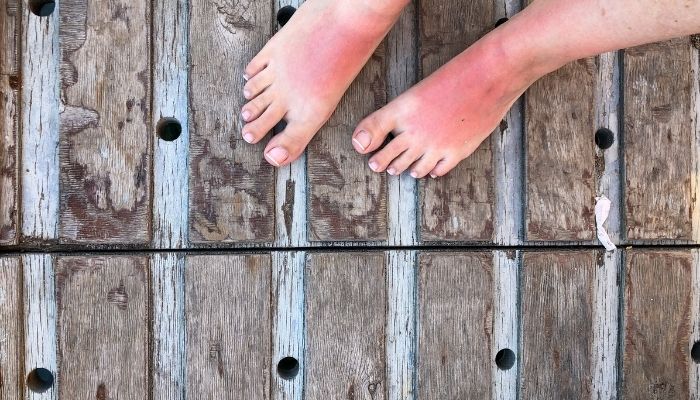 Home Remedies for treating burning feet