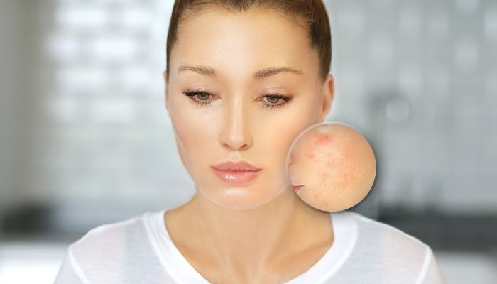 remove acne scars from oily skin naturally
