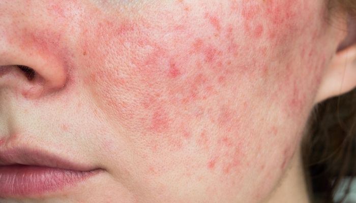 Greater Risk of Rosacea