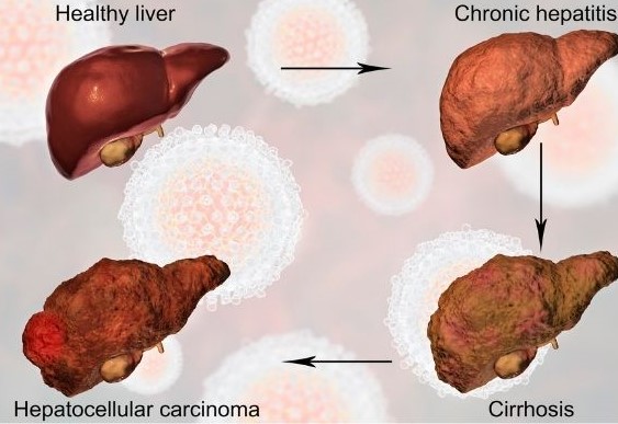 Liver Cirrhosis Stages 