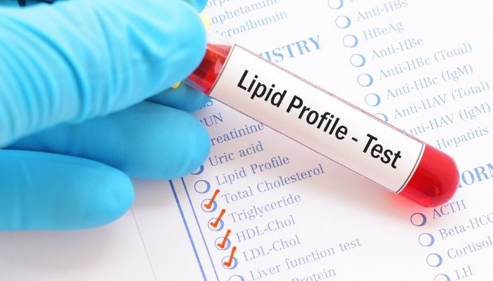 Lipid Profile Test Test Price Purpose Procedure Of Lipid Profile 