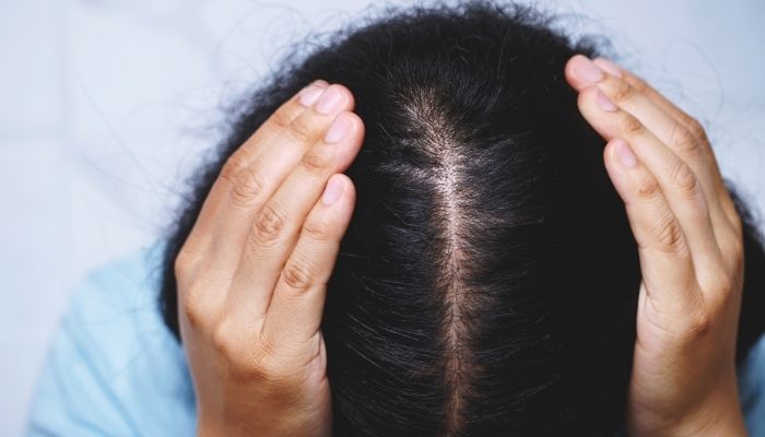 Receding Hairline In Women