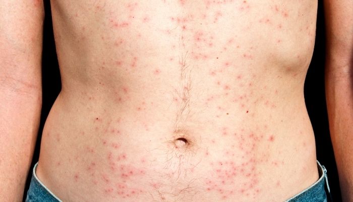 Folliculitis Treatment