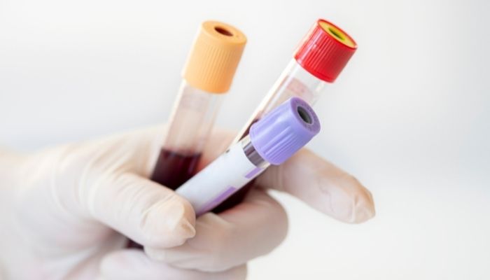 Creatine Phosphokinase Blood Test
