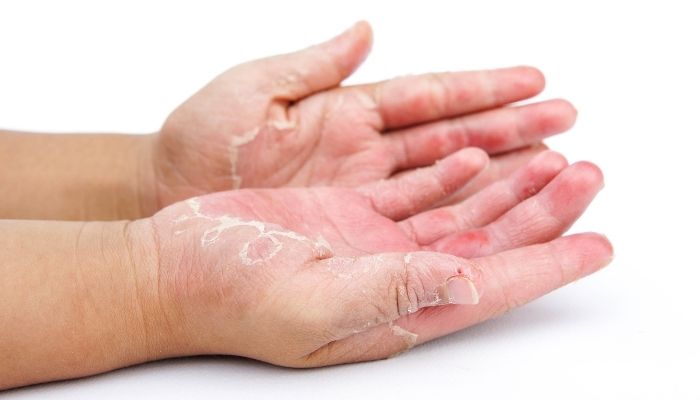 The Best Treatments For Tinea Versicolor And Red Patches