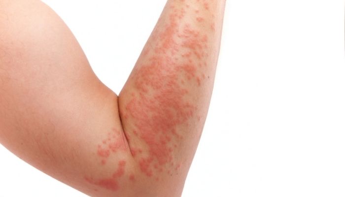 skin allergy test