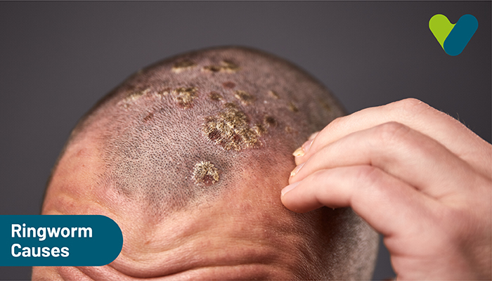 What is Ringworm (Hair), How is it Treated? | Este Medical Group