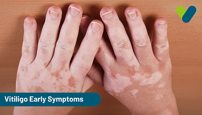 Vitiligo Early Symptoms