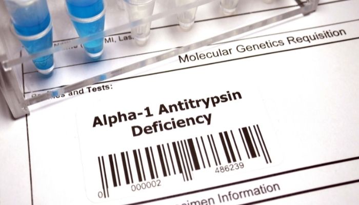 alpha-1 antitrypsin deficiency