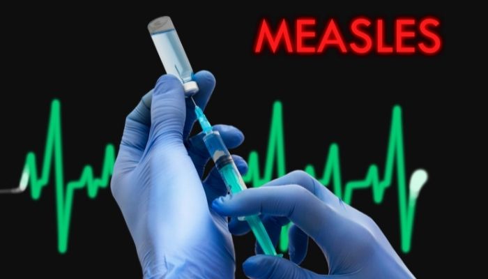 measles