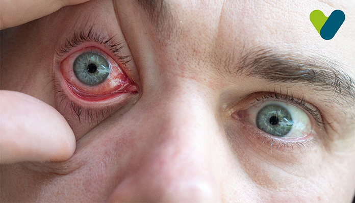11 Home Remedies for Red Eyes