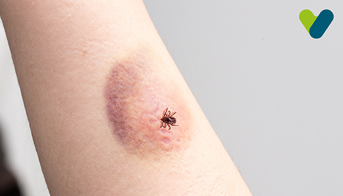 Are you a Tick Bite Victim? Check These Symptoms