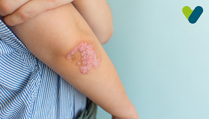 Psoriasis - Types Causes Symptoms and Treatment