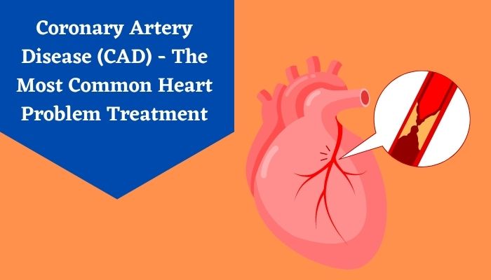 Coronary Artery Disease Cad The Most Common Heart Problem Treatment