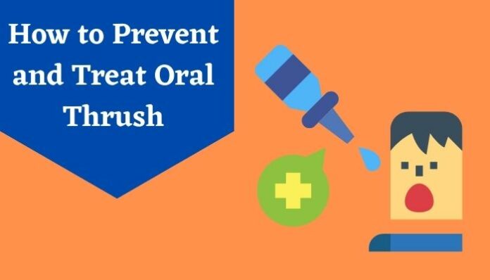 How to Prevent and Treat Oral Thrush