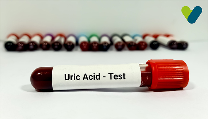 Treatment or Medicine of Uric Acid