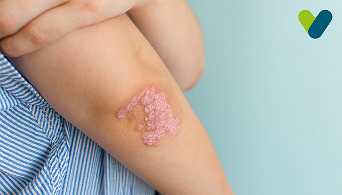 Treatments for Psoriasis: What Works and the Best Treatment