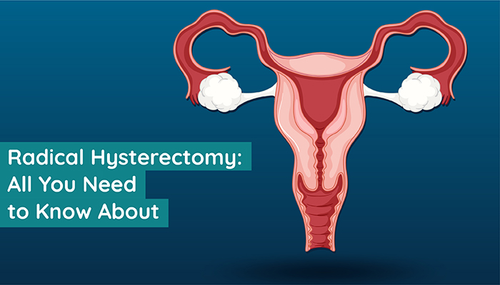 All You Need to Know about Radical Hysterectomy