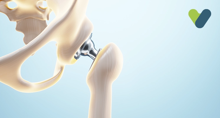 Surgery for hip fracture