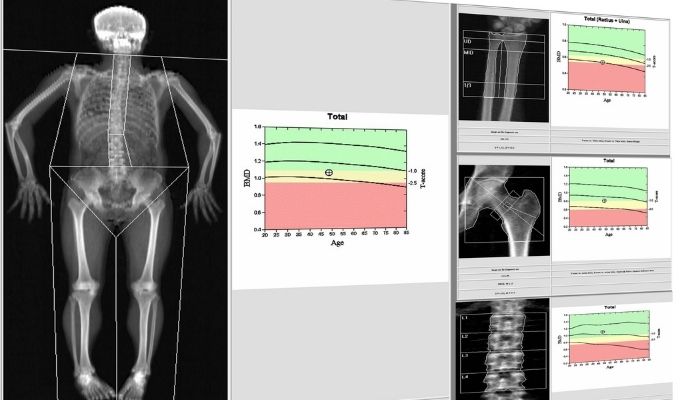 What Is A Bone Density Test?