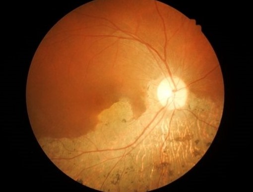 macular
