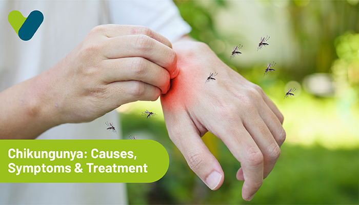 Chikungunya: Causes, Symptoms & Treatment