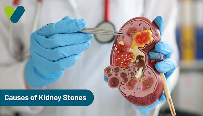 Causes of Kidney Stones