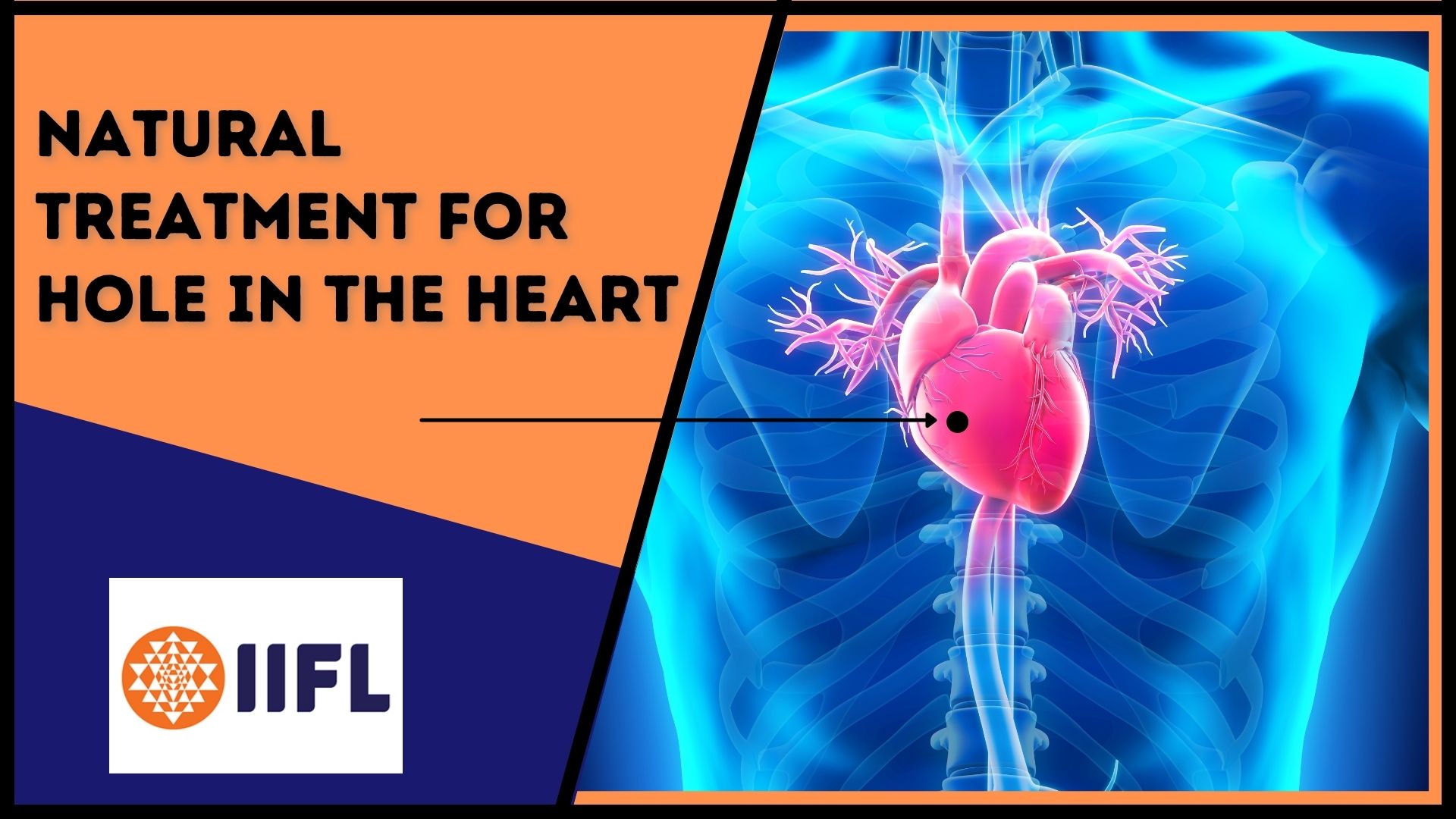 Top 3 natural treatment for hole in the heart livlong